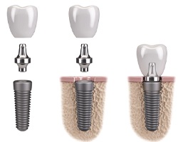 Detailed images of an implant, abutment, and dental crown