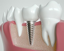 a digital illustration showing a dental implant fused with a jawbone