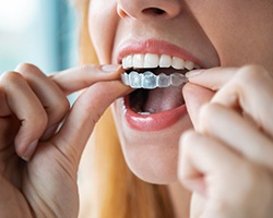 Nose-to-chin view of woman placing clear aligner over her teeth