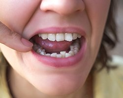 Nose-to-chin view of woman with crooked teeth pointing to them with one finger