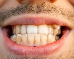 Closeup of a man’s underbite