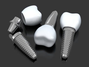 3D render of dental implants